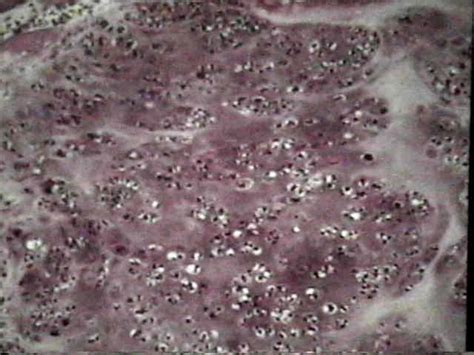 Histology of Chondrosarcoma : Wheeless' Textbook of Orthopaedics