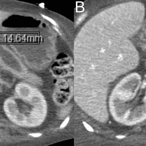 (A) CT pancreatic protocol showed a severely atrophic pancreas with a ...