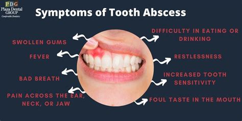 Causes Of Abscess Tooth