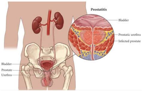 How To Treat Pelvic Pain Syndrome I Pillars of Wellness