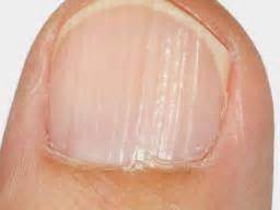 Ridges in fingernails: Types, causes, and treatment