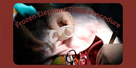 5 Useful Articles on the Frozen Elephant Trunk Procedure - CTSNet