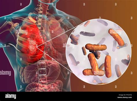 Pseudomonas infection hi-res stock photography and images - Alamy