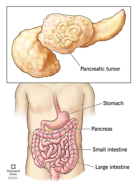 Pancreatic Cancer: Symptoms, Causes & Treatment