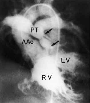 The Jugular Venous Pulse And The Arterial Pulse - Congenital Heart Disease