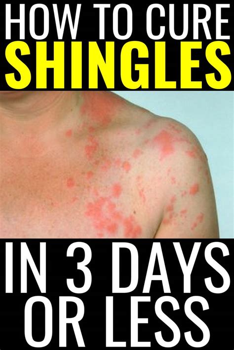 How To Cure Shingles In 3 Days Or Less, shingles remedies, natural ...