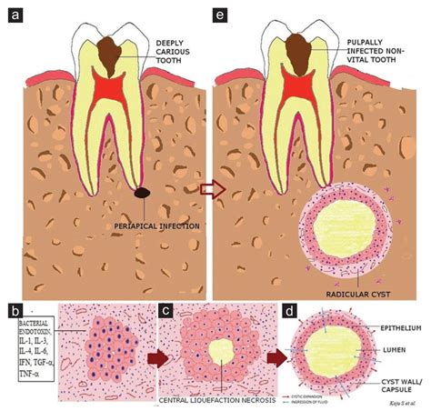 Pathogenesis of Radicular cyst (a) carious tooth showing a periapical ...