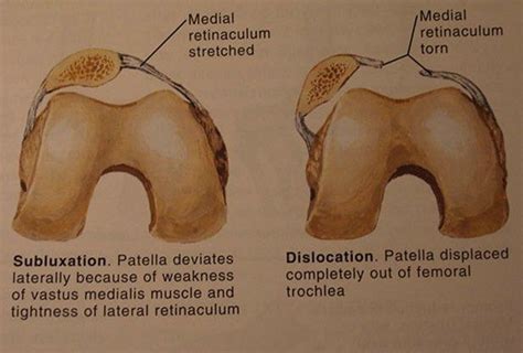 Image result for What causes patellar tracking disorder? | Patellar ...