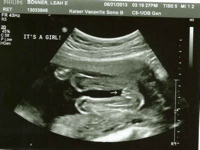 Short bus to minivan: Baby Girl, 20 Week Ultrasound