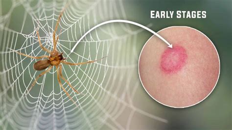 Brown Recluse Spider Bite Pictures Early Stages