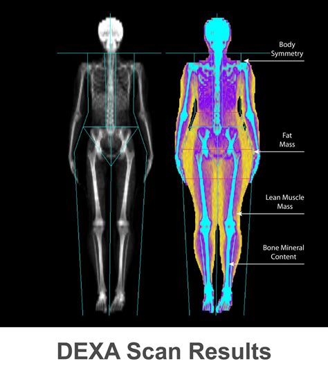 DEXA (DXA) Scan: Bone Density Test - Accurate Imaging Diagnostics