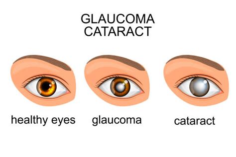 What is Glaucoma? | EYE Problems | Symptoms | Birla Hospital