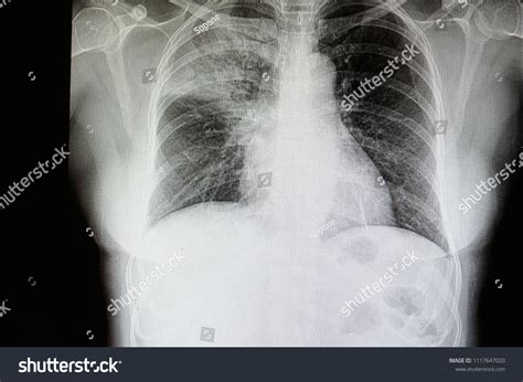 Lobar Pneumonia Chest Xray