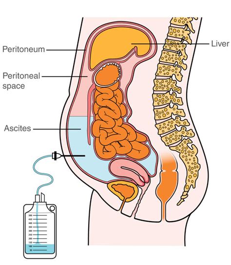 what causes fluid in cancer patients - Cheree Norwood