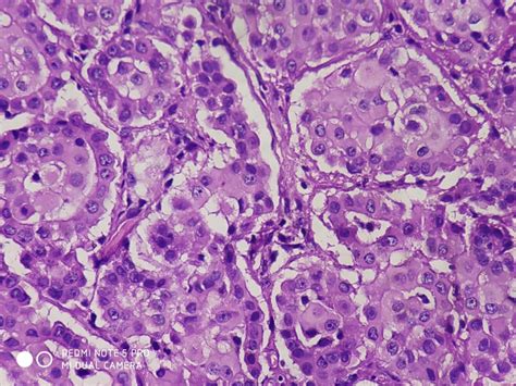 EPITHELIAL MALIGNANT MESOTHELIOMA – Histopathology.guru