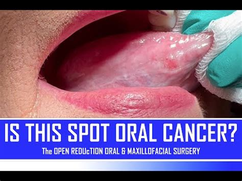 Is This Spot Oral Cancer?? | How To Identify Oral Cancer • Video ...