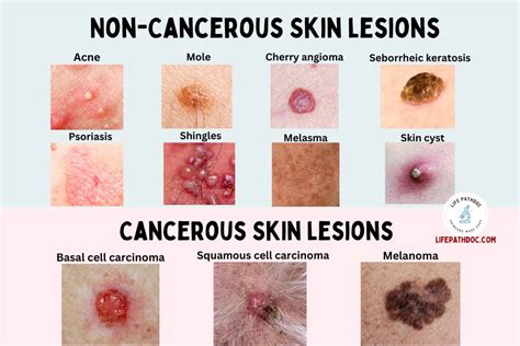 Skin Lesions Types – NBKomputer