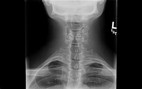 Cervical Spine Trauma Evaluation - Spine - Orthobullets