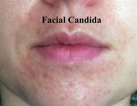 Candidiasis Rash