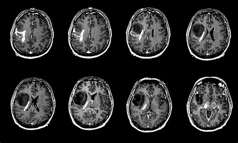 Brain MRI Tumor Detection with Convolutional Neural Network | by ...