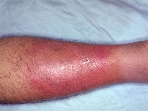 Treatment Options For Cellulitis: Kaminska Dermatology: Dermatologists