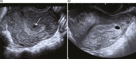 5 Week Gestational Sac Ultrasound