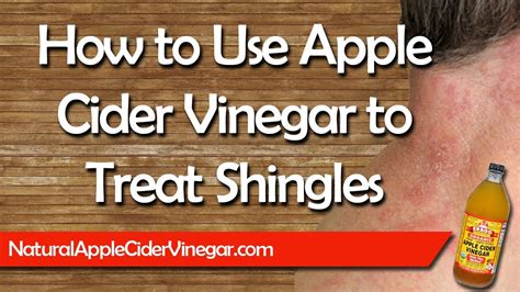 Apple Cider Vinegar for Shingles - Natural Home Remedy Treatment - YouTube