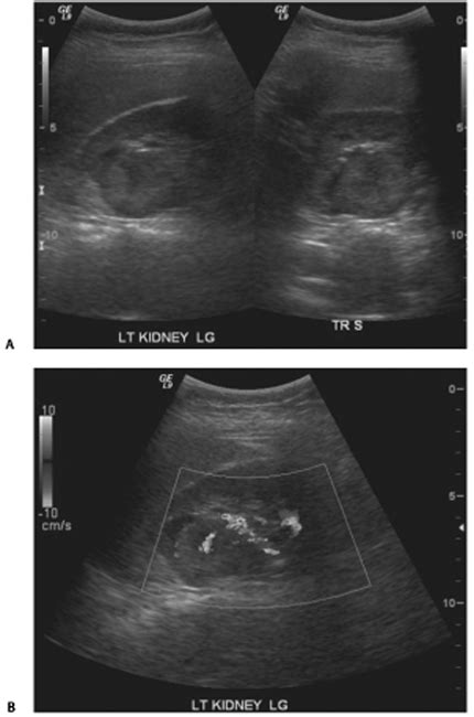 58 Oncocytoma | Radiology Key