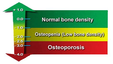 Bone Density Chart | T Score Chart - How to Understand