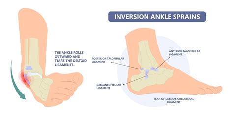 Ankle Sprain Grades