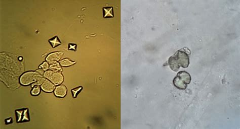 Calcium Oxalate Crystals - Nephrology in 30 days