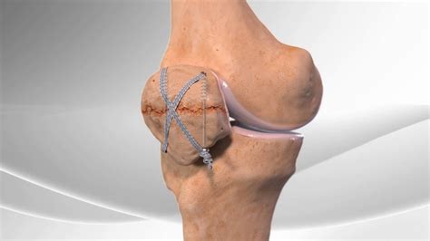 Patella Fracture Repair - YouTube