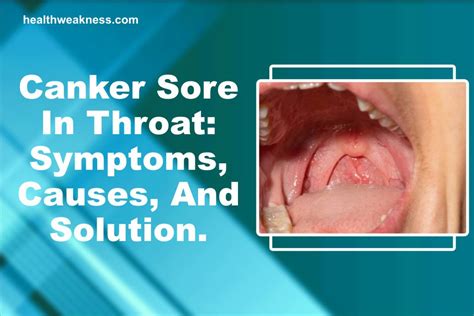 Canker Sore In Throat: Symptoms, Causes, And Solution (2022)