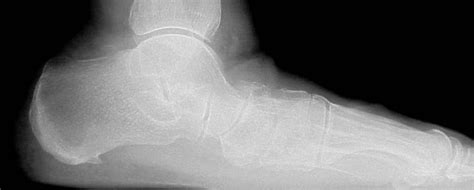 How To Address Subtalar Joint Instability