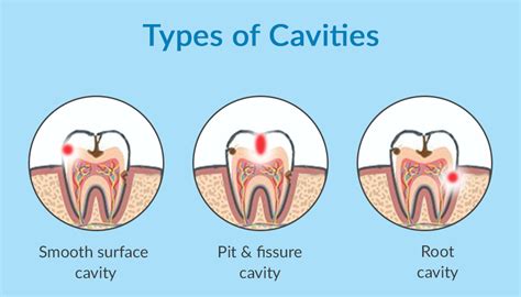 KEEP FREE OF CAVITIES AND GUM DISEASE THIS HALLOWEEN - Smile White Dental