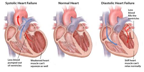 Systolic Heart Failure vs Diastolic Heart Failure: Symptoms, Diagnosis ...