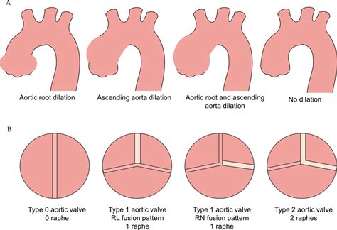 Determinants of aortic growth rate in patients with bicuspid aortic ...