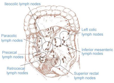 Lymph Nodes Colon Cancer Staging