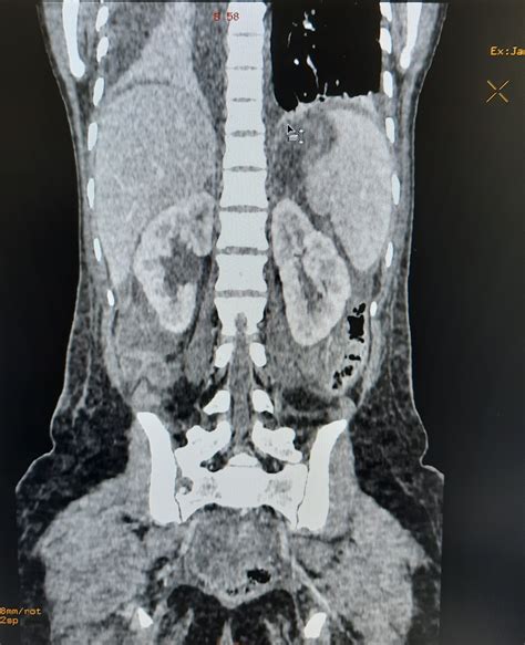 Cect Abdomen, Enterography – CT Abdomen – XrayDoctor Forum