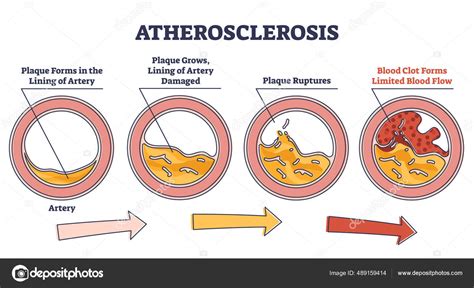 Atherosclerosis stages explanation and fatty plaque formation outline ...