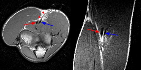 Distal Biceps Tendon Rupture Elbow - Radsource