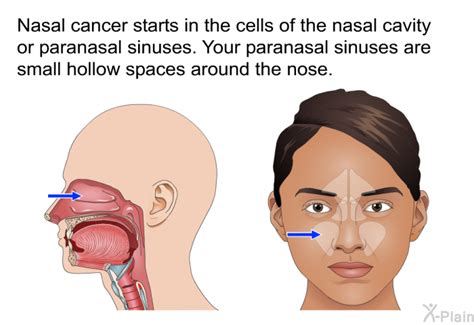 PatEdu.com : Nasal Cancer