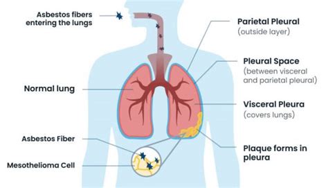 Pleural Mesothelioma Cancer: Everything You Need to Know