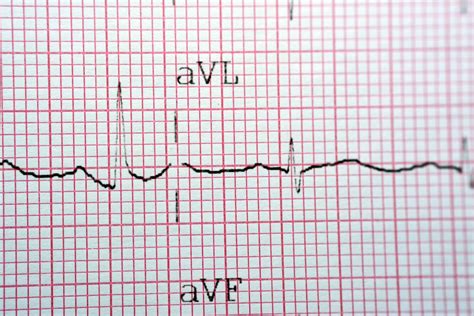 Top 50+ imagen heart palpitations but normal ecg - fr.thptnganamst.edu.vn