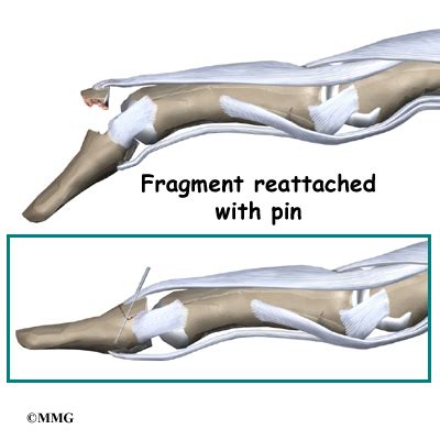 Mallet Finger: Extensor Tendon Injury | Houston Methodist