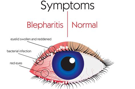 Eye Makeup For Blepharitis Sufferers - Science and Education