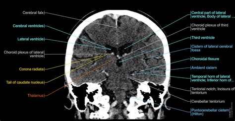 Normal Head CT Scan Anatomy Made Simple- Neuroradiology, 40% OFF