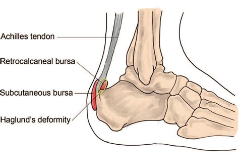 Superficial Calcaneal Bursitis - Sussex Foot And Ankle Clinic