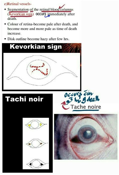 Kevorkian sign & Tache Noir ... #eye #postmortem #changes ( Note : Base ...