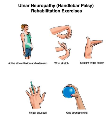 EXCLUSIVE PHYSIOTHERAPY GUIDE FOR PHYSIOTHERAPISTS: EXERCISE FOR ULNAR ...